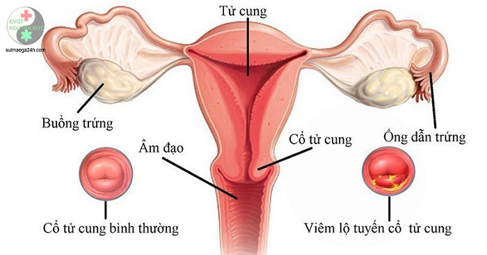 Bệnh viêm lộ tuyến tử cung: triệu chứng, nguyên nhân và điều trị