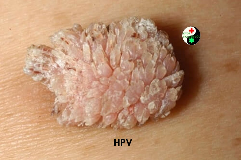 Sùi mào gà do HPV