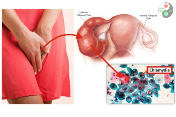 Cách nhận biết nhanh bệnh Chlamydia ở cả nam và nữ (6)