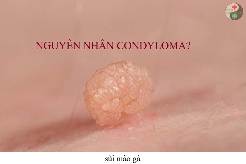 Nguyên nhân gây ra bệnh lý Condyloma?