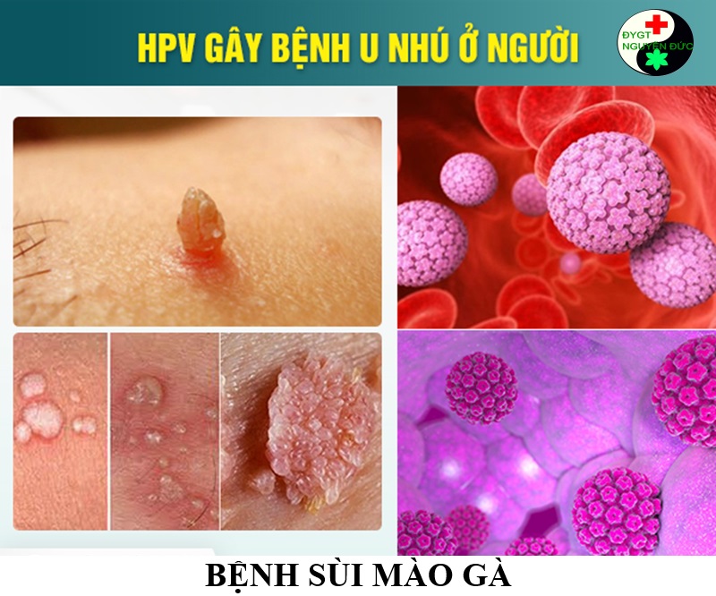 HPV là nguyên nhân sùi mào gà