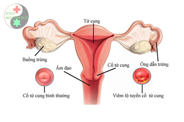 Đông y chữa Viêm lộ tuyến cổ tử cung có hết không (2)