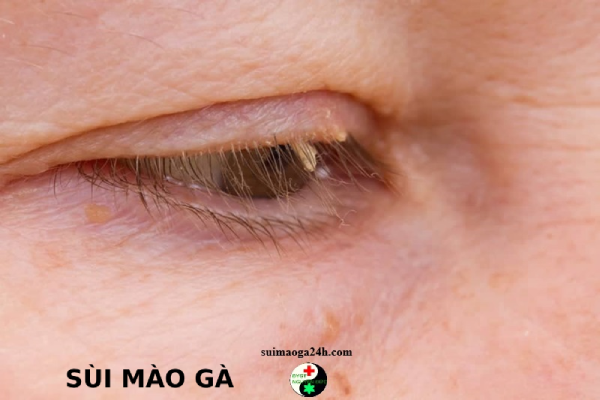 Giai đoạn đầu của bệnh sùi mào gà ở mắt và phương pháp điều trị bệnh