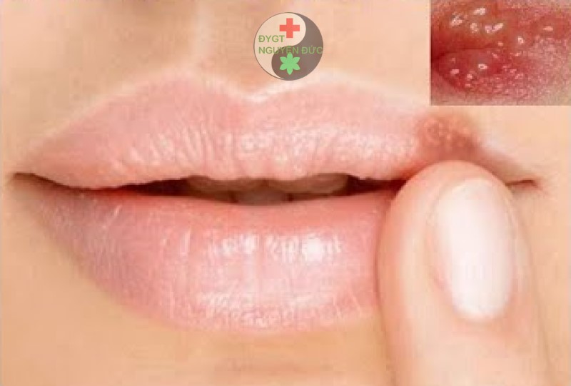  Điều trị sùi mào gà môi như thế nào ?