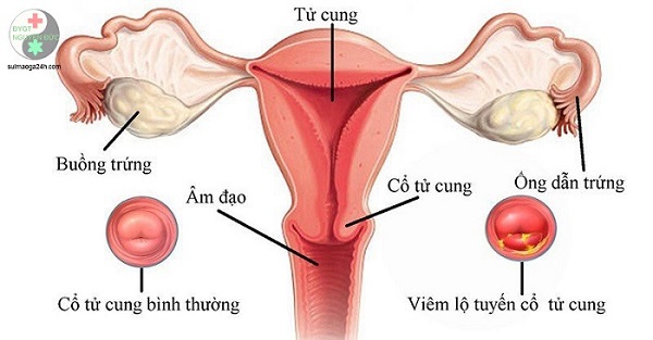 Những dấu hiệu khỏi bệnh viêm lộ tuyến tử cung