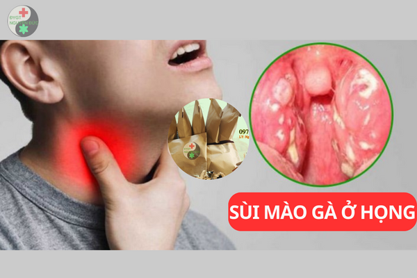 Những dấu hiệu nhận biết bệnh sùi mào gà ở cổ họng và cách phòng bệnh hiệu quả