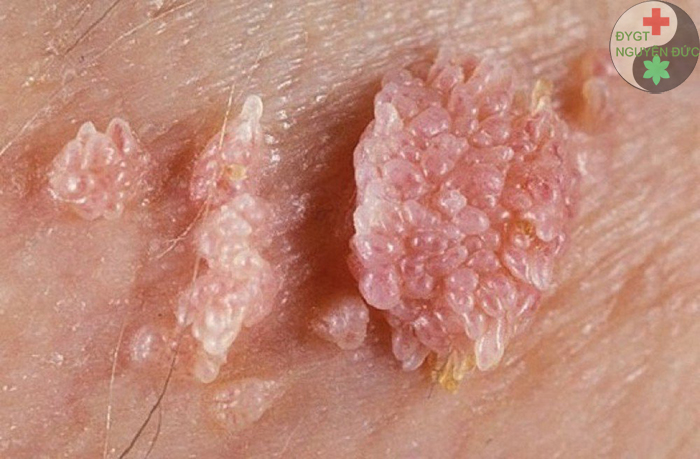 Phương thuốc đông y chữa sùi mào gà, tiêu diệt HPV của Lương Y Nguyễn Đức Thành