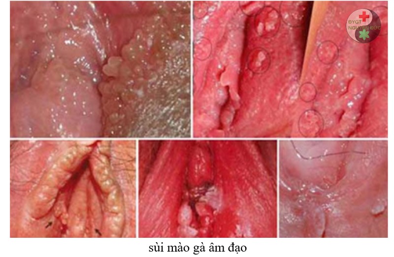 Sùi mào gà âm đạo