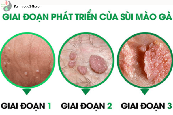 Thuốc trị sùi mào gà giai đoạn đầu (5)