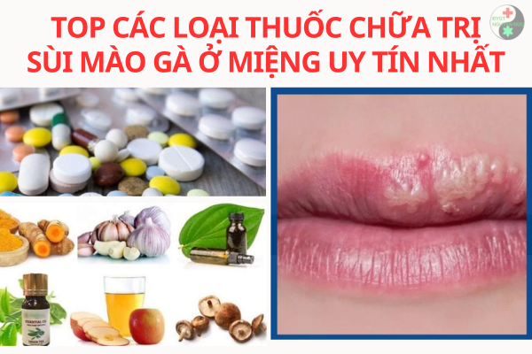 Top các loại thuốc chữa trị sùi mào gà ở miệng (1)