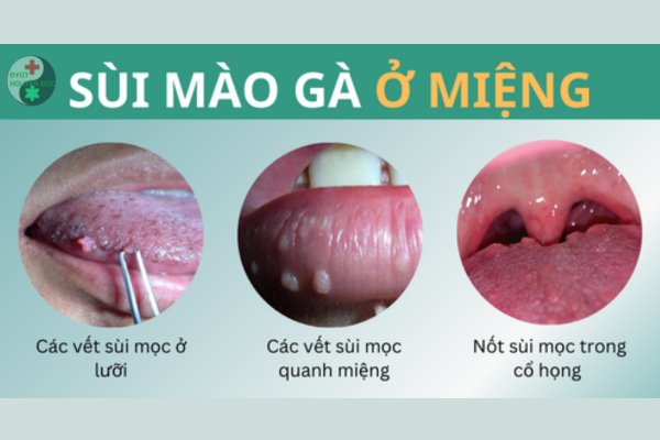 Top các loại thuốc chữa trị sùi mào gà ở miệng (3)