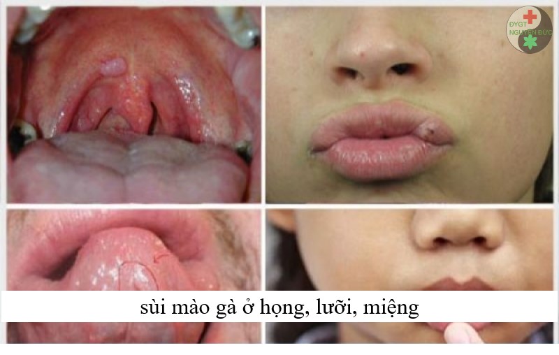 Dấu hiệu sùi mào gà ở miệng, lưỡi, họng