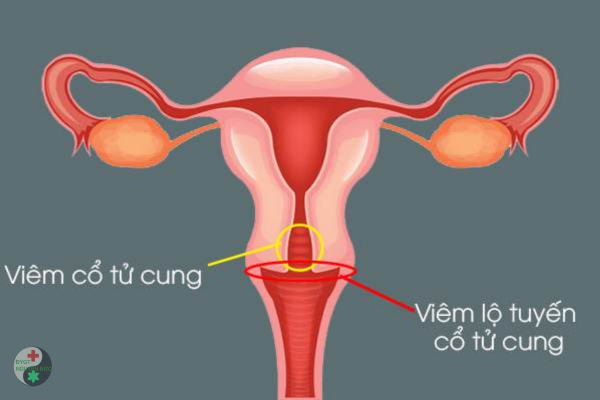 Viêm lộ tuyến cổ tử cung có gây ung thư không (2)