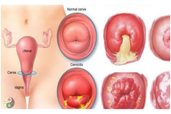 Viêm lộ tuyến cổ tử cung có gây ung thư không (4)