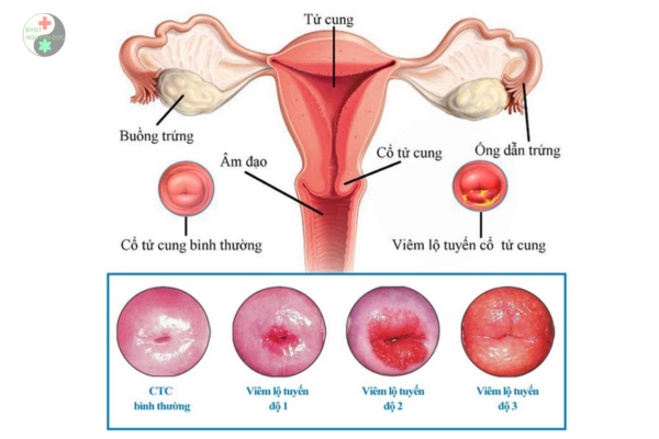 Viêm lộ tuyến cổ tử cung có gây ung thư không (5)