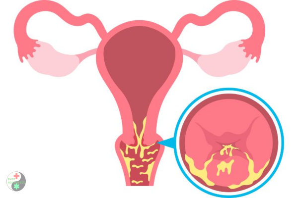 Viêm lộ tuyến cổ tử cung có gây ung thư không (8)
