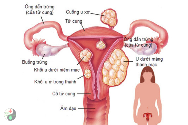 Viêm lộ tuyến cổ tử cung có gây ung thư không (9)