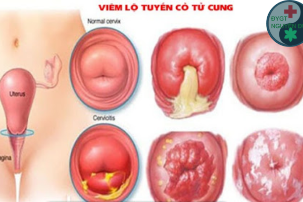 Viêm lộ tuyến và những biểu hiện của viêm lộ tuyến cổ tử cung phổ biến (1)