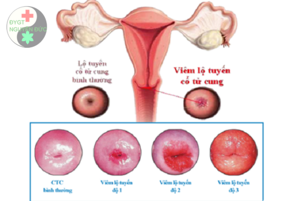 Viêm lộ tuyến và những biểu hiện của viêm lộ tuyến cổ tử cung phổ biến (3)