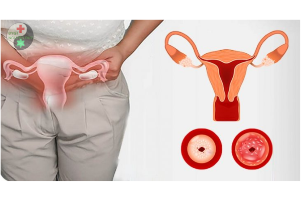 Viêm lộ tuyến và những biểu hiện của viêm lộ tuyến cổ tử cung phổ biến (7)