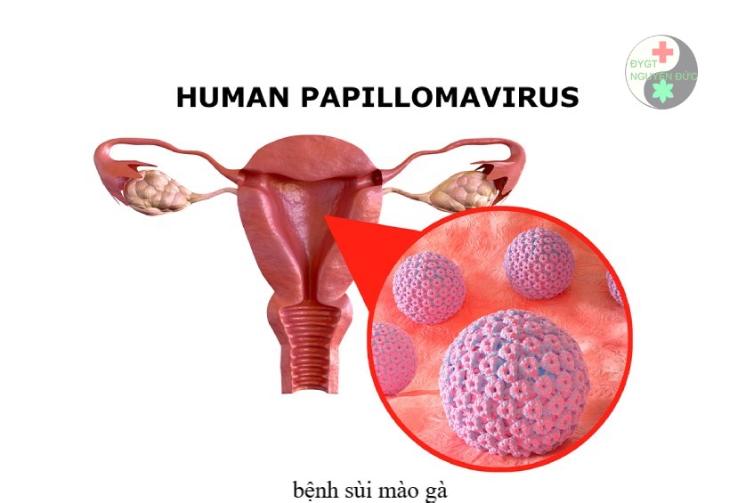 Virus HPV gây bệnh sùi mào gà