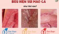 Bệnh sùi mào gà có biểu hiện như thế nào?