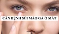 Căn bệnh sùi mào gà ở mắt