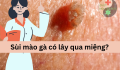 Sùi mào gà lây qua miệng- nước bọt không