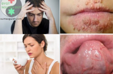 Mức Độ Nguy Hiểm Của Bệnh Sùi Mào Gà Ở Miệng Và Cách Điều Trị