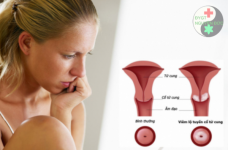 Tổng hợp những thông tin chi tiết về viêm lộ tuyến cổ tử cung