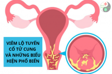 Viêm lộ tuyến và những biểu hiện của viêm lộ tuyến cổ tử cung phổ biến